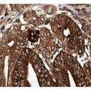 AF0578 at 1/100 staining human Stomach cancer tissue sections by IHC-P. The tissue was formaldehyde fixed and a heat mediated antigen retrieval step in citrate buffer was performed. The tissue was then blocked and incubated with the antibody for 1.5 hours at 22¡ãC. An HRP conjugated goat anti-rabbit antibody was used as the secondary