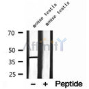 DF12213 at 1/100 staining Human lymph cancer tissue by IHC-P. The sample was formaldehyde fixed and a heat mediated antigen retrieval step in citrate buffer was performed. The sample was then blocked and incubated with the antibody for 1.5 hours at 22¡ãC. An HRP conjugated goat anti-rabbit antibody was used as the secondary