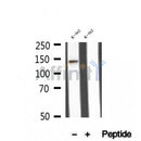 DF12296 at 1/100 staining Human breast cancer tissue by IHC-P. The sample was formaldehyde fixed and a heat mediated antigen retrieval step in citrate buffer was performed. The sample was then blocked and incubated with the antibody for 1.5 hours at 22¡ãC. An HRP conjugated goat anti-rabbit antibody was used as the secondary