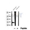 DF12299 at 1/100 staining Human breast cancer tissue by IHC-P. The sample was formaldehyde fixed and a heat mediated antigen retrieval step in citrate buffer was performed. The sample was then blocked and incubated with the antibody for 1.5 hours at 22¡ãC. An HRP conjugated goat anti-rabbit antibody was used as the secondary