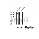 DF12354 at 1/100 staining Human lymph cancer tissue by IHC-P. The sample was formaldehyde fixed and a heat mediated antigen retrieval step in citrate buffer was performed. The sample was then blocked and incubated with the antibody for 1.5 hours at 22¡ãC. An HRP conjugated goat anti-rabbit antibody was used as the secondary