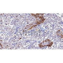 AF0262 at 1/100 staining Human urothelial cancer tissue by IHC-P. The sample was formaldehyde fixed and a heat mediated antigen retrieval step in citrate buffer was performed. The sample was then blocked and incubated with the antibody for 1.5 hours at 22¡ãC. An HRP conjugated goat anti-rabbit antibody was used as the secondary