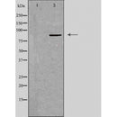 DF3290 at 1/100 staining Human breast cancer tissue by IHC-P. The sample was formaldehyde fixed and a heat mediated antigen retrieval step in citrate buffer was performed. The sample was then blocked and incubated with the antibody for 1.5 hours at 22¡ãC. An HRP conjugated goat anti-rabbit antibody was used as the secondary