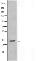 DF4399 at 1/100 staining Human lung cancer tissue by IHC-P. The sample was formaldehyde fixed and a heat mediated antigen retrieval step in citrate buffer was performed. The sample was then blocked and incubated with the antibody for 1.5 hours at 22¡ãC. An HRP conjugated goat anti-rabbit antibody was used as the secondary