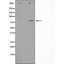 DF4809 at 1/100 staining Human breast cancer tissue by IHC-P. The sample was formaldehyde fixed and a heat mediated antigen retrieval step in citrate buffer was performed. The sample was then blocked and incubated with the antibody for 1.5 hours at 22¡ãC. An HRP conjugated goat anti-rabbit antibody was used as the secondary