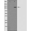 AF5148 at 1/100 staining Human urothelial cancer tissue by IHC-P. The sample was formaldehyde fixed and a heat mediated antigen retrieval step in citrate buffer was performed. The sample was then blocked and incubated with the antibody for 1.5 hours at 22¡ãC. An HRP conjugated goat anti-rabbit antibody was used as the secondary
