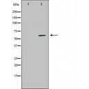 DF6004 at 1/100 staining Human urothelial cancer tissue by IHC-P. The sample was formaldehyde fixed and a heat mediated antigen retrieval step in citrate buffer was performed. The sample was then blocked and incubated with the antibody for 1.5 hours at 22¡ãC. An HRP conjugated goat anti-rabbit antibody was used as the secondary