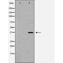 DF6029 at 1/100 staining Human brain cancer tissue by IHC-P. The sample was formaldehyde fixed and a heat mediated antigen retrieval step in citrate buffer was performed. The sample was then blocked and incubated with the antibody for 1.5 hours at 22¡ãC. An HRP conjugated goat anti-rabbit antibody was used as the secondary