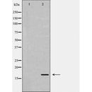 DF6099 at 1/100 staining Human urothelial cancer tissue by IHC-P. The sample was formaldehyde fixed and a heat mediated antigen retrieval step in citrate buffer was performed. The sample was then blocked and incubated with the antibody for 1.5 hours at 22¡ãC. An HRP conjugated goat anti-rabbit antibody was used as the secondary