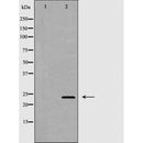 DF6125 at 1/100 staining Human lung cancer tissue by IHC-P. The sample was formaldehyde fixed and a heat mediated antigen retrieval step in citrate buffer was performed. The sample was then blocked and incubated with the antibody for 1.5 hours at 22¡ãC. An HRP conjugated goat anti-rabbit antibody was used as the secondary