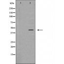 DF6142 at 1/100 staining Human liver cancer tissue by IHC-P. The sample was formaldehyde fixed and a heat mediated antigen retrieval step in citrate buffer was performed. The sample was then blocked and incubated with the antibody for 1.5 hours at 22¡ãC. An HRP conjugated goat anti-rabbit antibody was used as the secondary