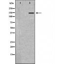 DF6144 at 1/100 staining Human urothelial cancer tissue by IHC-P. The sample was formaldehyde fixed and a heat mediated antigen retrieval step in citrate buffer was performed. The sample was then blocked and incubated with the antibody for 1.5 hours at 22¡ãC. An HRP conjugated goat anti-rabbit antibody was used as the secondary