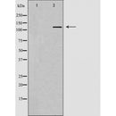 DF6164 at 1/100 staining Human breast cancer tissue by IHC-P. The sample was formaldehyde fixed and a heat mediated antigen retrieval step in citrate buffer was performed. The sample was then blocked and incubated with the antibody for 1.5 hours at 22¡ãC. An HRP conjugated goat anti-rabbit antibody was used as the secondary