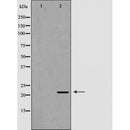 DF6226 at 1/100 staining Human Melanoma tissue by IHC-P. The sample was formaldehyde fixed and a heat mediated antigen retrieval step in citrate buffer was performed. The sample was then blocked and incubated with the antibody for 1.5 hours at 22¡ãC. An HRP conjugated goat anti-rabbit antibody was used as the secondary