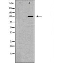 DF6706 at 1/100 staining Human liver cancer tissue by IHC-P. The sample was formaldehyde fixed and a heat mediated antigen retrieval step in citrate buffer was performed. The sample was then blocked and incubated with the antibody for 1.5 hours at 22¡ãC. An HRP conjugated goat anti-rabbit antibody was used as the secondary