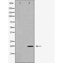 DF6812 at 1/100 staining Human Melanoma tissue by IHC-P. The sample was formaldehyde fixed and a heat mediated antigen retrieval step in citrate buffer was performed. The sample was then blocked and incubated with the antibody for 1.5 hours at 22¡ãC. An HRP conjugated goat anti-rabbit antibody was used as the secondary