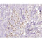 AF0508 at 1/100 staining human Breast cancer tissue sections by IHC-P. The tissue was formaldehyde fixed and a heat mediated antigen retrieval step in citrate buffer was performed. The tissue was then blocked and incubated with the antibody for 1.5 hours at 22¡ãC. An HRP conjugated goat anti-rabbit antibody was used as the secondary