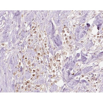 AF0508 at 1/100 staining human Breast cancer tissue sections by IHC-P. The tissue was formaldehyde fixed and a heat mediated antigen retrieval step in citrate buffer was performed. The tissue was then blocked and incubated with the antibody for 1.5 hours at 22¡ãC. An HRP conjugated goat anti-rabbit antibody was used as the secondary