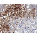 IHC analysis of human gastric cancer tissue, using GLUT1 Antibody at 1/100