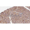 AF0173 at 1/100 staining Human liver cancer tissue by IHC-P. The sample was formaldehyde fixed and a heat mediated antigen retrieval step in citrate buffer was performed. The sample was then blocked and incubated with the antibody for 1.5 hours at 22¡ãC. An HRP conjugated goat anti-rabbit antibody was used as the secondary