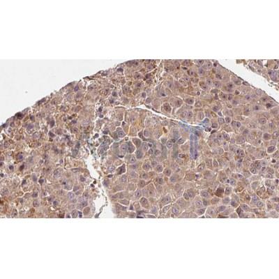 AF0173 at 1/100 staining Human liver cancer tissue by IHC-P. The sample was formaldehyde fixed and a heat mediated antigen retrieval step in citrate buffer was performed. The sample was then blocked and incubated with the antibody for 1.5 hours at 22¡ãC. An HRP conjugated goat anti-rabbit antibody was used as the secondary