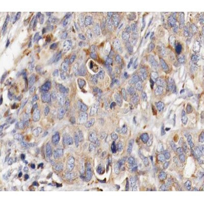AF0465 at 1/100 staining human ovarian cancer tissue sections by IHC-P. The tissue was formaldehyde fixed and a heat mediated antigen retrieval step in citrate buffer was performed. The tissue was then blocked and incubated with the antibody for 1.5 hours at 22¡ãC. An HRP conjugated goat anti-rabbit antibody was used as the secondary