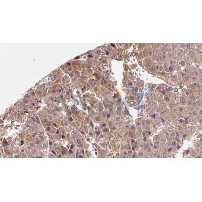 AF0174 at 1/100 staining Human liver cancer tissue by IHC-P. The sample was formaldehyde fixed and a heat mediated antigen retrieval step in citrate buffer was performed. The sample was then blocked and incubated with the antibody for 1.5 hours at 22¡ãC. An HRP conjugated goat anti-rabbit antibody was used as the secondary