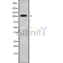 DF10104 at 1/100 staining Human liver cancer tissue by IHC-P. The sample was formaldehyde fixed and a heat mediated antigen retrieval step in citrate buffer was performed. The sample was then blocked and incubated with the antibody for 1.5 hours at 22¡ãC. An HRP conjugated goat anti-rabbit antibody was used as the secondary