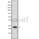 DF10157 at 1/100 staining Human liver cancer tissue by IHC-P. The sample was formaldehyde fixed and a heat mediated antigen retrieval step in citrate buffer was performed. The sample was then blocked and incubated with the antibody for 1.5 hours at 22¡ãC. An HRP conjugated goat anti-rabbit antibody was used as the secondary