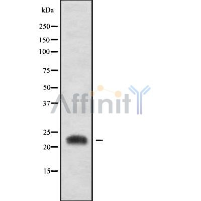 DF10157 at 1/100 staining Human liver cancer tissue by IHC-P. The sample was formaldehyde fixed and a heat mediated antigen retrieval step in citrate buffer was performed. The sample was then blocked and incubated with the antibody for 1.5 hours at 22¡ãC. An HRP conjugated goat anti-rabbit antibody was used as the secondary