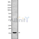 DF10170 at 1/100 staining Human liver cancer tissue by IHC-P. The sample was formaldehyde fixed and a heat mediated antigen retrieval step in citrate buffer was performed. The sample was then blocked and incubated with the antibody for 1.5 hours at 22¡ãC. An HRP conjugated goat anti-rabbit antibody was used as the secondary