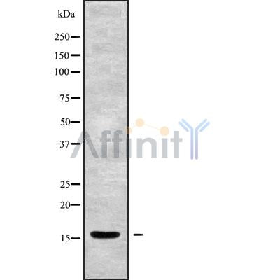 DF10170 at 1/100 staining Human liver cancer tissue by IHC-P. The sample was formaldehyde fixed and a heat mediated antigen retrieval step in citrate buffer was performed. The sample was then blocked and incubated with the antibody for 1.5 hours at 22¡ãC. An HRP conjugated goat anti-rabbit antibody was used as the secondary