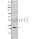 DF10180 at 1/100 staining Human Melanoma tissue by IHC-P. The sample was formaldehyde fixed and a heat mediated antigen retrieval step in citrate buffer was performed. The sample was then blocked and incubated with the antibody for 1.5 hours at 22¡ãC. An HRP conjugated goat anti-rabbit antibody was used as the secondary
