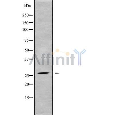 DF10185 at 1/100 staining Human lung cancer tissue by IHC-P. The sample was formaldehyde fixed and a heat mediated antigen retrieval step in citrate buffer was performed. The sample was then blocked and incubated with the antibody for 1.5 hours at 22¡ãC. An HRP conjugated goat anti-rabbit antibody was used as the secondary