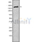 DF10200 at 1/100 staining Human liver cancer tissue by IHC-P. The sample was formaldehyde fixed and a heat mediated antigen retrieval step in citrate buffer was performed. The sample was then blocked and incubated with the antibody for 1.5 hours at 22¡ãC. An HRP conjugated goat anti-rabbit antibody was used as the secondary