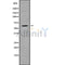 DF10202 at 1/100 staining Human liver cancer tissue by IHC-P. The sample was formaldehyde fixed and a heat mediated antigen retrieval step in citrate buffer was performed. The sample was then blocked and incubated with the antibody for 1.5 hours at 22¡ãC. An HRP conjugated goat anti-rabbit antibody was used as the secondary