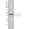 DF10205 at 1/100 staining Human liver cancer tissue by IHC-P. The sample was formaldehyde fixed and a heat mediated antigen retrieval step in citrate buffer was performed. The sample was then blocked and incubated with the antibody for 1.5 hours at 22¡ãC. An HRP conjugated goat anti-rabbit antibody was used as the secondary