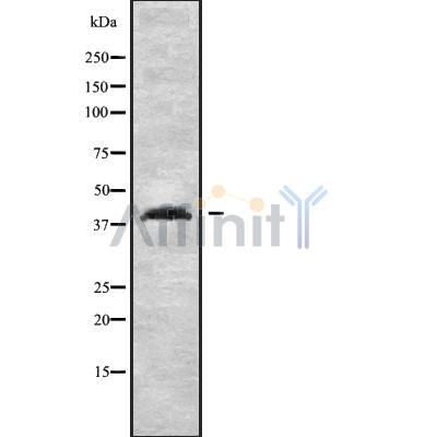 DF10205 at 1/100 staining Human liver cancer tissue by IHC-P. The sample was formaldehyde fixed and a heat mediated antigen retrieval step in citrate buffer was performed. The sample was then blocked and incubated with the antibody for 1.5 hours at 22¡ãC. An HRP conjugated goat anti-rabbit antibody was used as the secondary