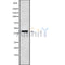 DF10206 at 1/100 staining Human liver cancer tissue by IHC-P. The sample was formaldehyde fixed and a heat mediated antigen retrieval step in citrate buffer was performed. The sample was then blocked and incubated with the antibody for 1.5 hours at 22¡ãC. An HRP conjugated goat anti-rabbit antibody was used as the secondary