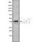 DF10223 at 1/100 staining Human liver cancer tissue by IHC-P. The sample was formaldehyde fixed and a heat mediated antigen retrieval step in citrate buffer was performed. The sample was then blocked and incubated with the antibody for 1.5 hours at 22¡ãC. An HRP conjugated goat anti-rabbit antibody was used as the secondary