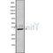 DF10239 at 1/100 staining Human liver cancer tissue by IHC-P. The sample was formaldehyde fixed and a heat mediated antigen retrieval step in citrate buffer was performed. The sample was then blocked and incubated with the antibody for 1.5 hours at 22¡ãC. An HRP conjugated goat anti-rabbit antibody was used as the secondary