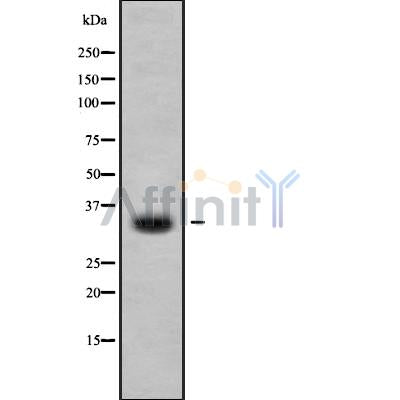 DF10241 at 1/100 staining Human liver cancer tissue by IHC-P. The sample was formaldehyde fixed and a heat mediated antigen retrieval step in citrate buffer was performed. The sample was then blocked and incubated with the antibody for 1.5 hours at 22¡ãC. An HRP conjugated goat anti-rabbit antibody was used as the secondary