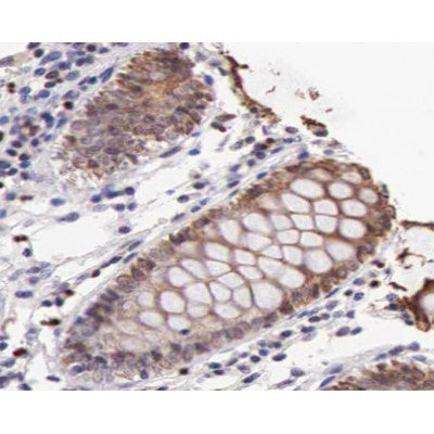 AF0176 at 1/100 staining human colon carcinoma tissue sections by IHC-P. The tissue was formaldehyde fixed and a heat mediated antigen retrieval step in citrate buffer was performed. The tissue was then blocked and incubated with the antibody for 1.5 hours at 22¡ãC. An HRP conjugated goat anti-rabbit antibody was used as the secondary