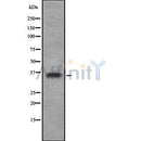 DF10288 at 1/100 staining Human liver cancer tissue by IHC-P. The sample was formaldehyde fixed and a heat mediated antigen retrieval step in citrate buffer was performed. The sample was then blocked and incubated with the antibody for 1.5 hours at 22¡ãC. An HRP conjugated goat anti-rabbit antibody was used as the secondary