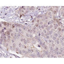 AF0177 at 1/100 staining human liver carcinoma tissue sections by IHC-P. The tissue was formaldehyde fixed and a heat mediated antigen retrieval step in citrate buffer was performed. The tissue was then blocked and incubated with the antibody for 1.5 hours at 22¡ãC. An HRP conjugated goat anti-rabbit antibody was used as the secondary