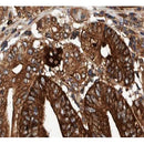 AF0578 at 1/100 staining human Stomach cancer tissue sections by IHC-P. The tissue was formaldehyde fixed and a heat mediated antigen retrieval step in citrate buffer was performed. The tissue was then blocked and incubated with the antibody for 1.5 hours at 22¡ãC. An HRP conjugated goat anti-rabbit antibody was used as the secondary