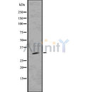 DF7509 at 1/100 staining Human liver cancer tissue by IHC-P. The sample was formaldehyde fixed and a heat mediated antigen retrieval step in citrate buffer was performed. The sample was then blocked and incubated with the antibody for 1.5 hours at 22¡ãC. An HRP conjugated goat anti-rabbit antibody was used as the secondary