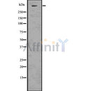 DF7512 at 1/100 staining Human breast cancer tissue by IHC-P. The sample was formaldehyde fixed and a heat mediated antigen retrieval step in citrate buffer was performed. The sample was then blocked and incubated with the antibody for 1.5 hours at 22¡ãC. An HRP conjugated goat anti-rabbit antibody was used as the secondary