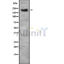 DF7513 at 1/100 staining Human urothelial cancer tissue by IHC-P. The sample was formaldehyde fixed and a heat mediated antigen retrieval step in citrate buffer was performed. The sample was then blocked and incubated with the antibody for 1.5 hours at 22¡ãC. An HRP conjugated goat anti-rabbit antibody was used as the secondary