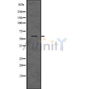 DF7526 at 1/100 staining Human breast cancer tissue by IHC-P. The sample was formaldehyde fixed and a heat mediated antigen retrieval step in citrate buffer was performed. The sample was then blocked and incubated with the antibody for 1.5 hours at 22¡ãC. An HRP conjugated goat anti-rabbit antibody was used as the secondary
